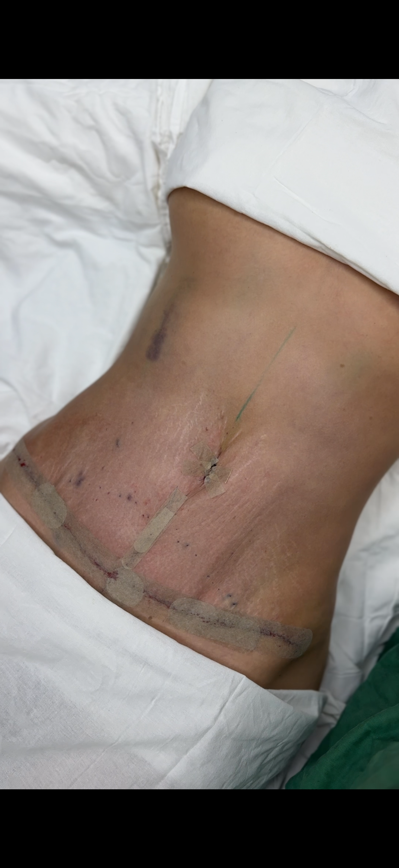 Абдоминопластика